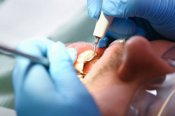 Best Emergency Tooth Extraction in High Point, NC
